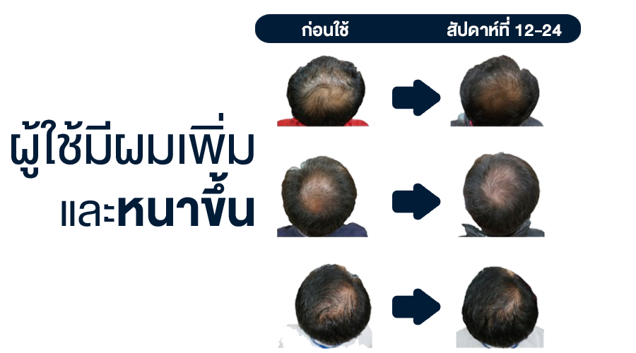 H-Pro สารอาหารสำหรับผม