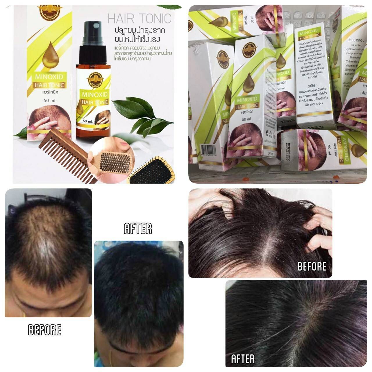 Hair tonic minoxid arbutina แฮร์ โทนิค